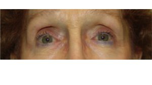 Manhattan BLEPHAROPLASTY Before 3